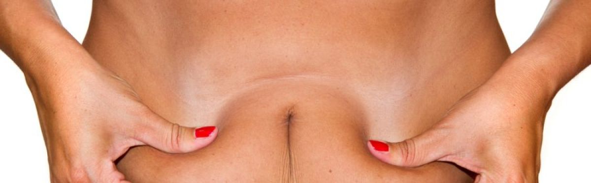 liposcultura non chirurgica
